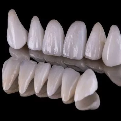 Al momento stai visualizzando Faccette dentali: cosa sono e come funzionano