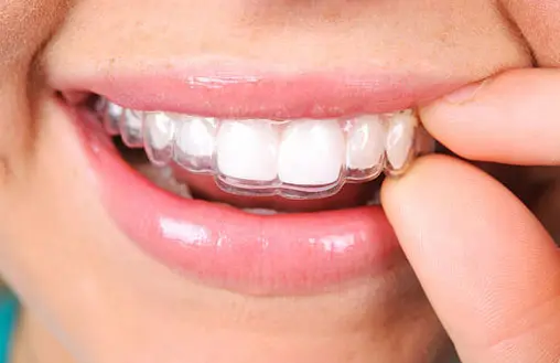 Al momento stai visualizzando Mascherine ortodontiche invisibili: la soluzione per un sorriso perfetto