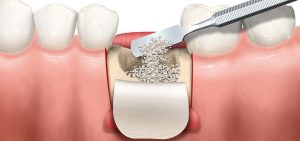 Scopri di più sull'articolo La rigenerazione ossea in odontoiatria: come funziona e quali sono i vantaggi