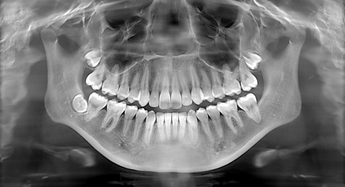 Al momento stai visualizzando Radiografie in odontoiatria: perché sono importanti e come funzionano