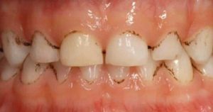 Scopri di più sull'articolo I cibi che macchiano i denti: come prevenirne gli effetti indesiderati