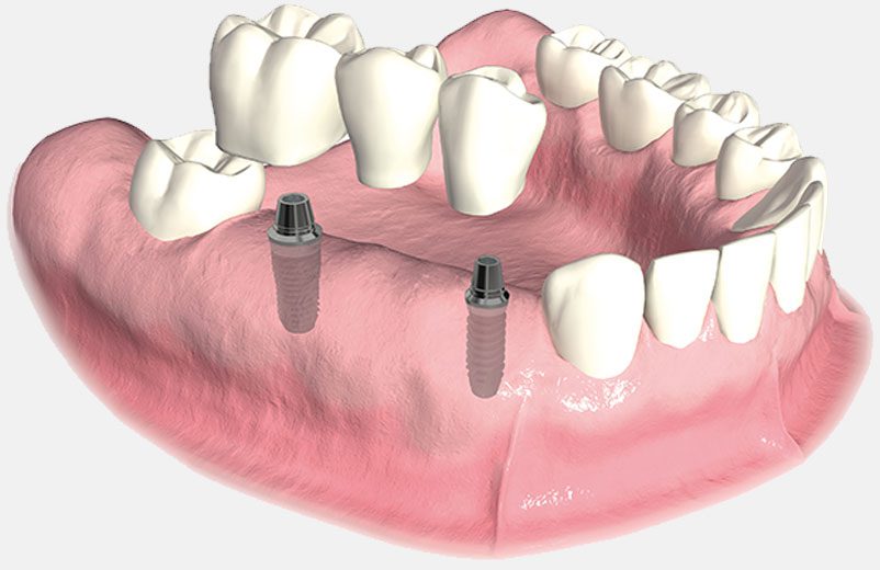 Al momento stai visualizzando Ponti su impianti dentali: tutto quello che devi sapere