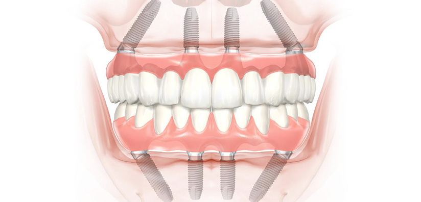Scopri di più sull'articolo All-on-Four: il trattamento innovativo per il restauro dentale completo